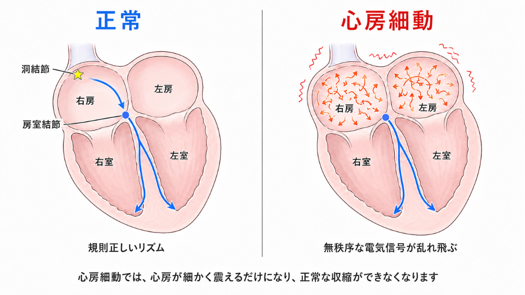 正常vs心房細動