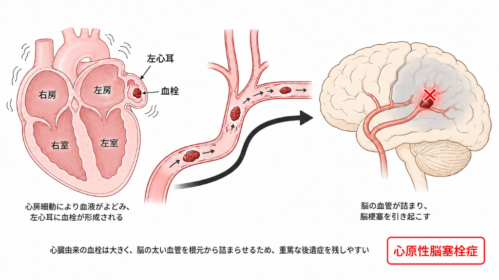 心原性脳塞栓