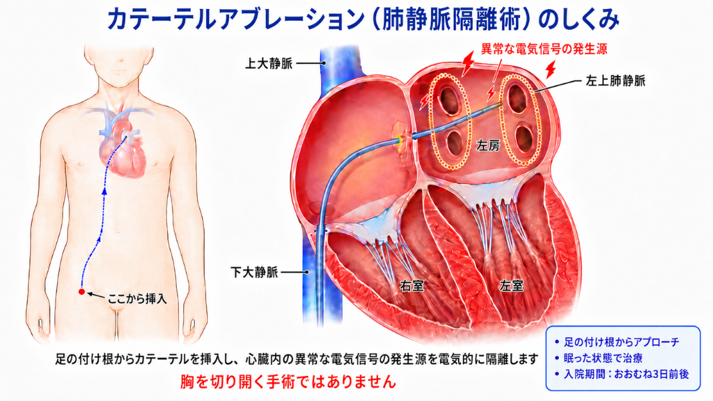 カテーテルアブレーション