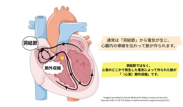 期外収縮の図式